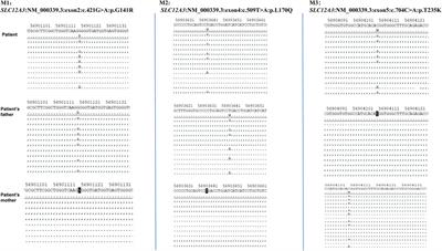 Case report: Two novel compound heterozygous variant of SLC12A3 gene in a gitelman syndrome family and literature review